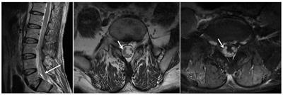 Neuroblastoma of the lumbosacral canal in an adult: a case report and literature review